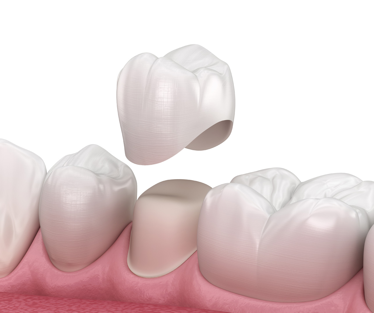 Dental Crowns