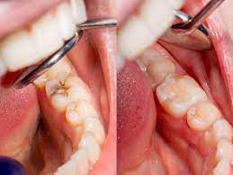 Dental Fillings