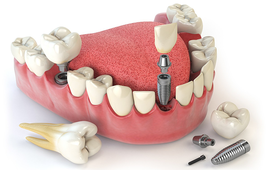 Dental Implants