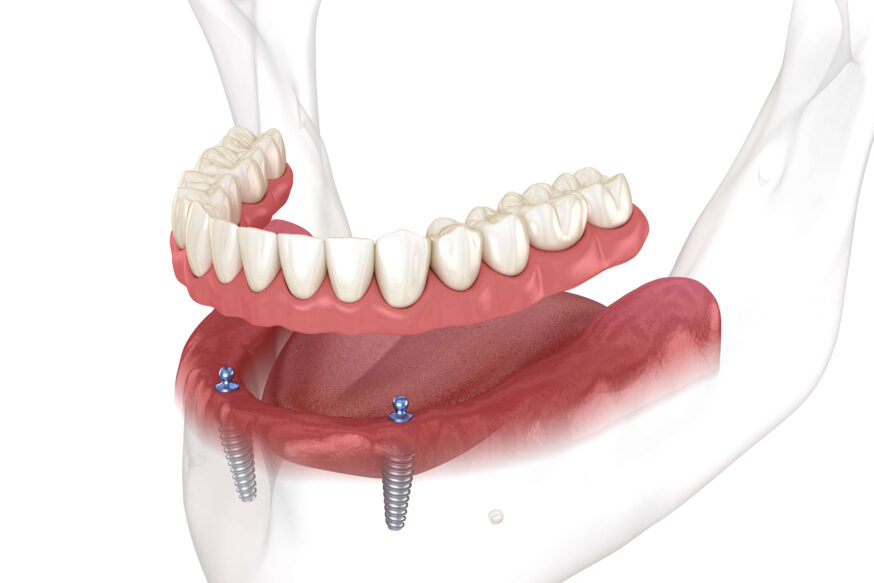 Implant Retained Dentures