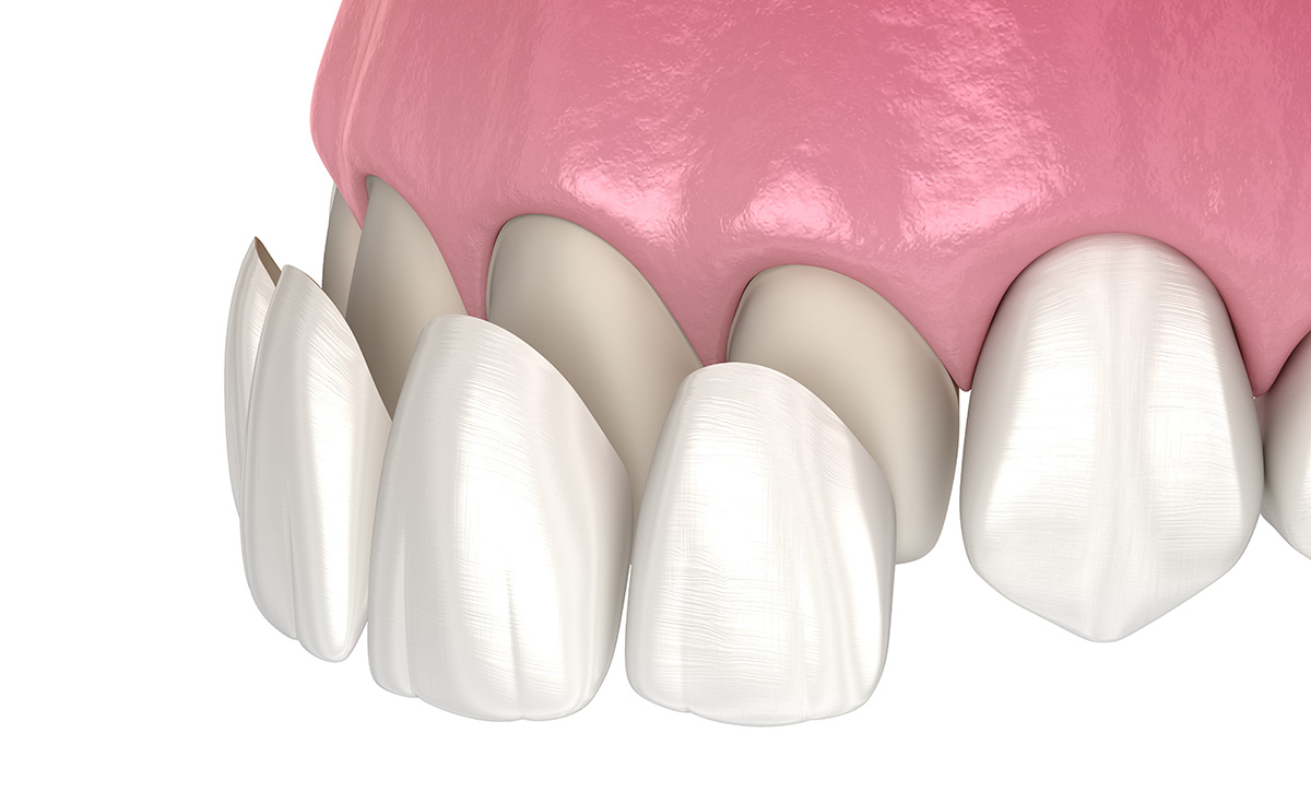 Porcelain Veneers