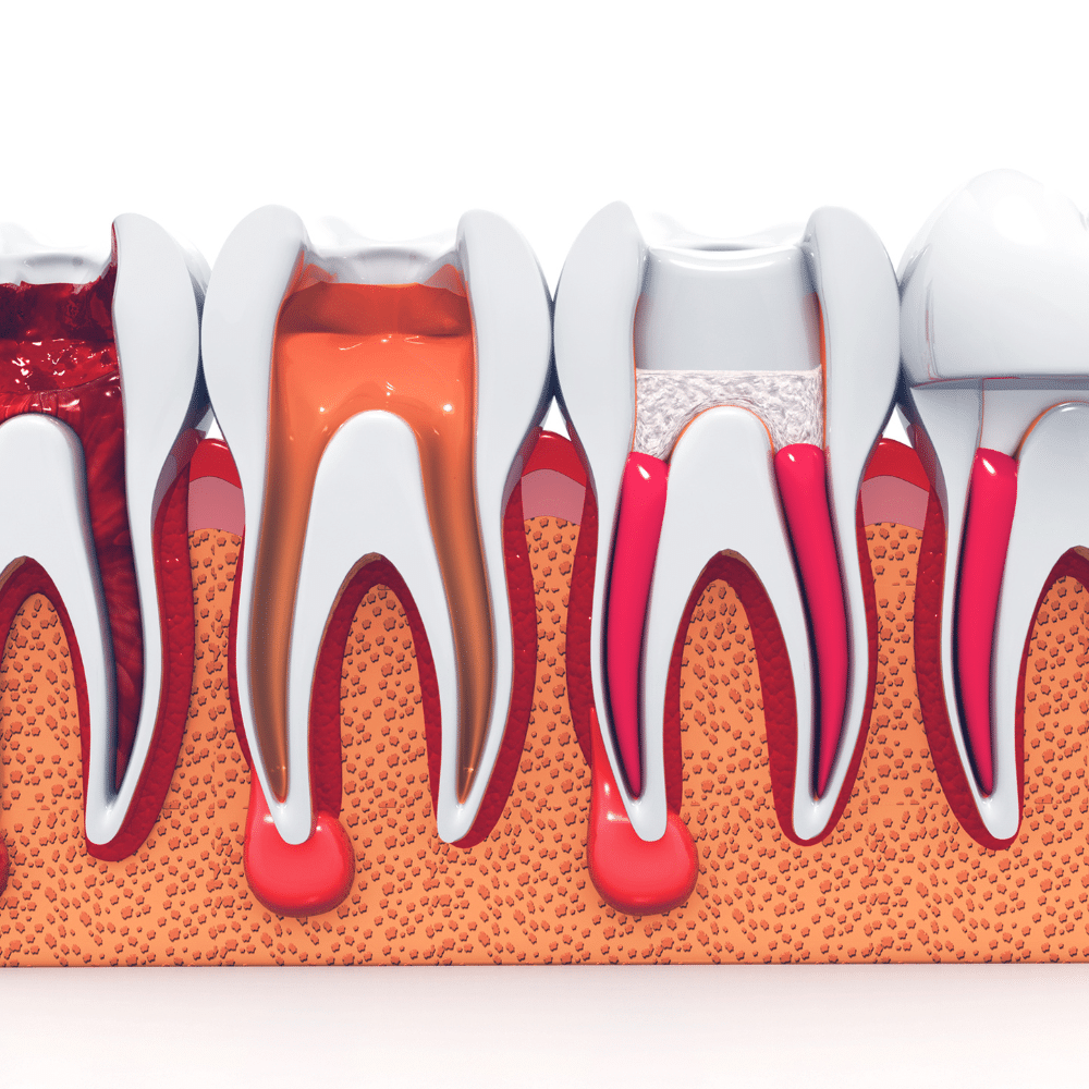 The process of a root canal.
